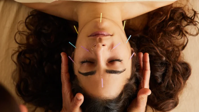 Acupuncture in Adelaide 1